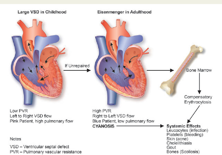 Hội chứng Eisenmenger phát triển khi có quá nhiều máu chảy qua các động mạch mang máu đến phổi từ tim, từ đó gây tăng áp động mạch phổi - huyết áp cao trong các mạch máu của phổi và bên phải của tim.
