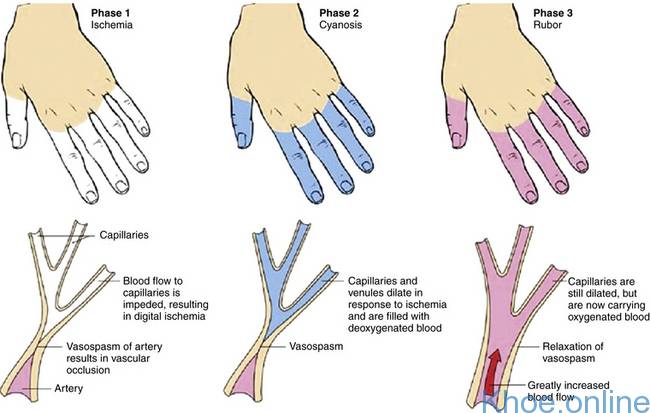 Một người mắc hội chứng Raynaud có thể trải qua 3 giai đoạn thay đổi màu da: trắng (xanh xao), xanh lam (tím tái) và đỏ (hồng ngọc).