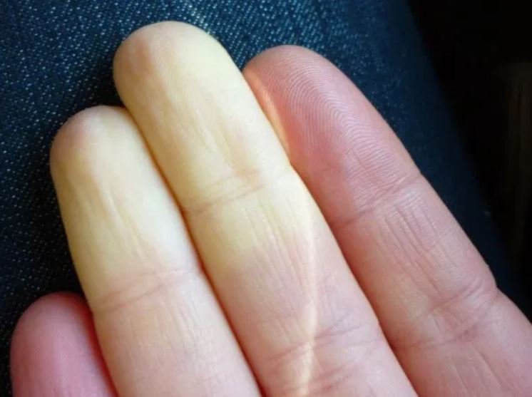 Phụ nữ có nhiều khả năng mắc chứng rối loạn này hơn nam giới.