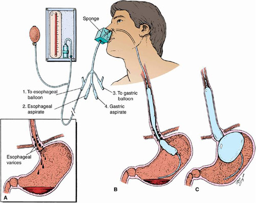 Bệnh nhân tiểu đường nhiều năm chống chỉ đặt sonde dạ dày sau đột quỵ?