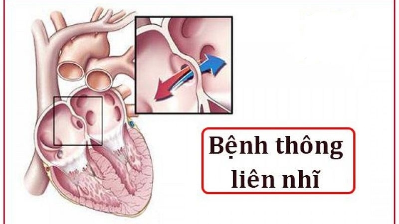 Nguyên nhân chính xác của dị tật vách liên nhĩ vẫn chưa được biết đầy đủ.