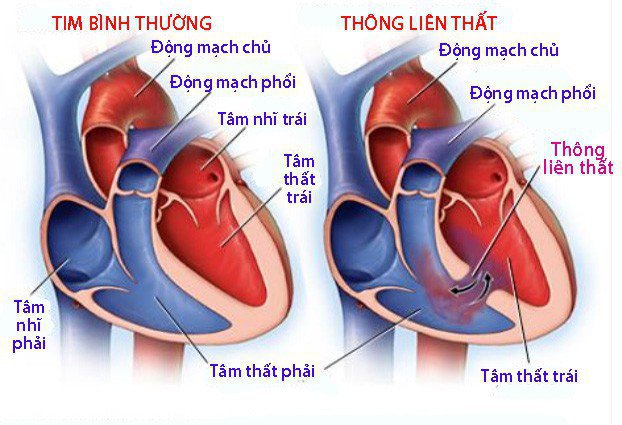 Thông liên nhĩ là một lỗ trên vách ngăn tâm nhĩ - bức tường ngăn cách hai buồng trên của tim (tâm nhĩ).