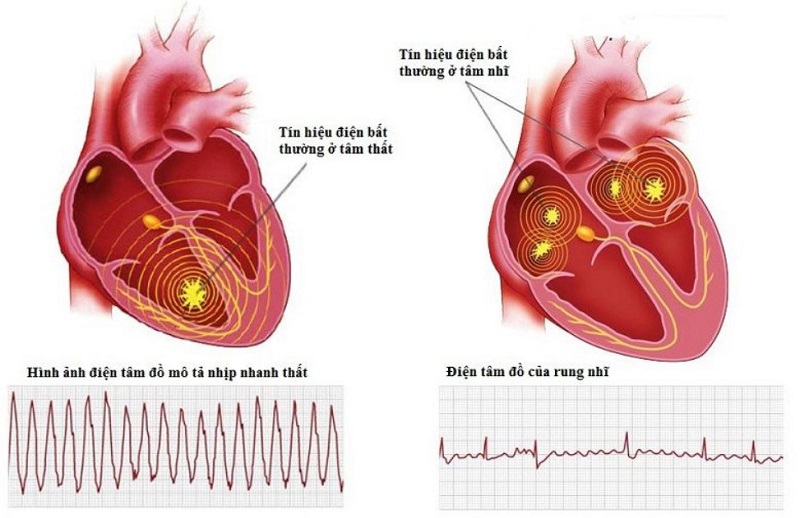 Nhịp nhanh thất không duy trì là loại tự ngừng trong vòng 30 giây.