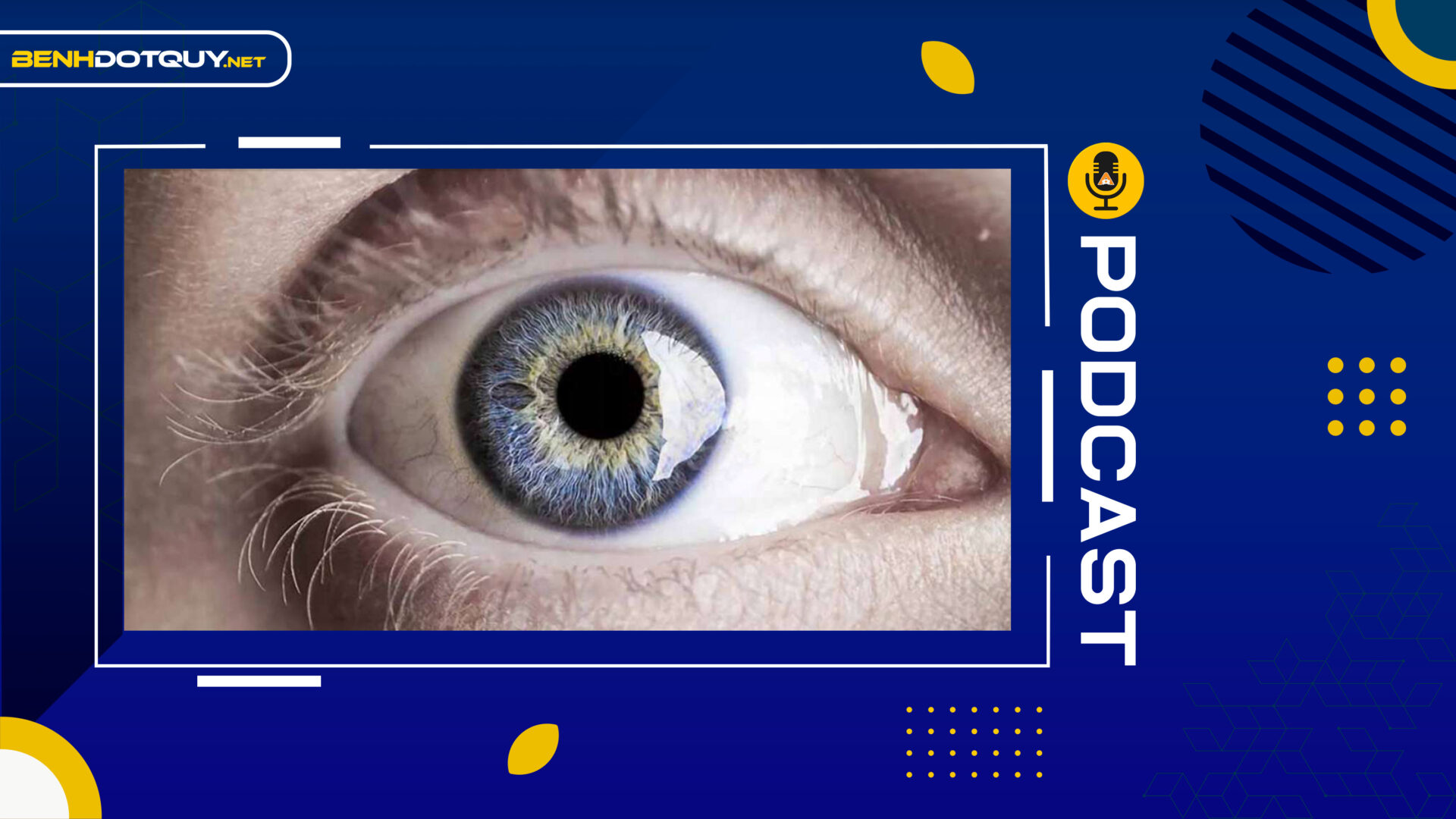 Triệu chứng cảnh báo đột quỵ mắt