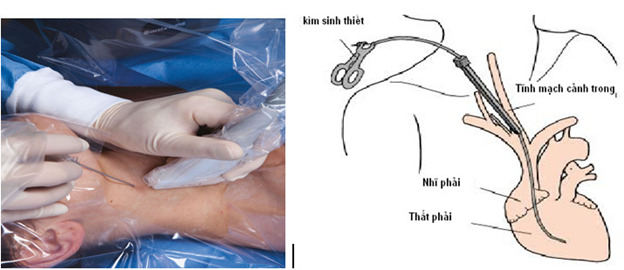 Sinh thiết nội mạc cơ tim giúp phát hiện những thay đổi trong các tế bào cho thấy tổn thương hoặc bất thường.
