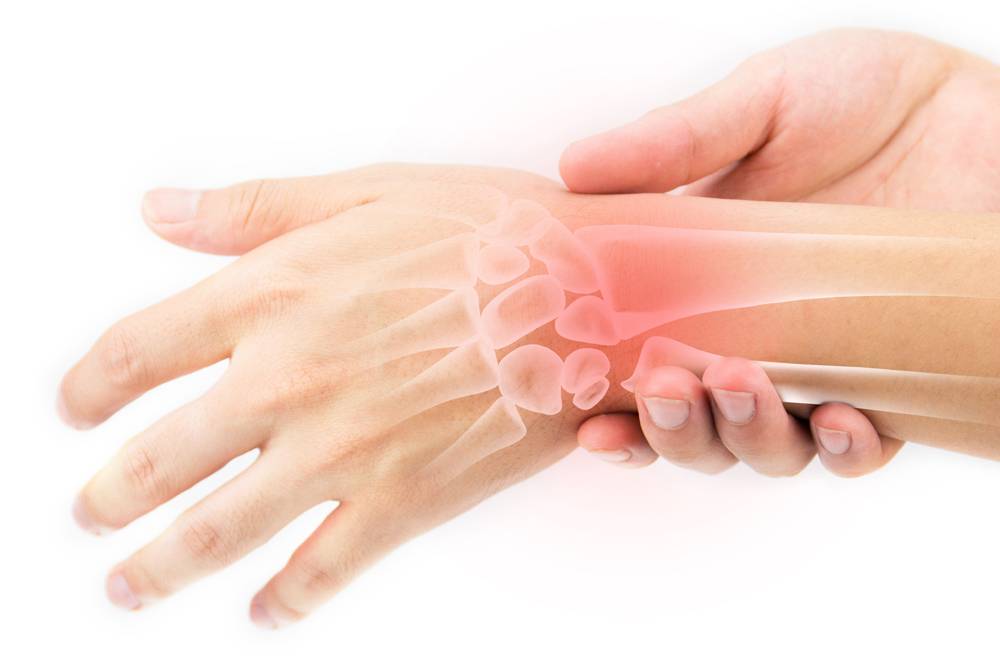 Sốt thấp khớp là nguyên nhân phổ biến nhất của hẹp van hai lá. 