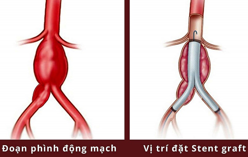 Phương pháp điều trị phình động mạch chủ bụng?