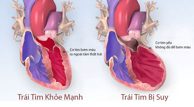 Suy tim sung huyết (CHF), là một bệnh diễn tiến mạn tính gây ảnh hưởng lên sức bơm máu của cơ tim.