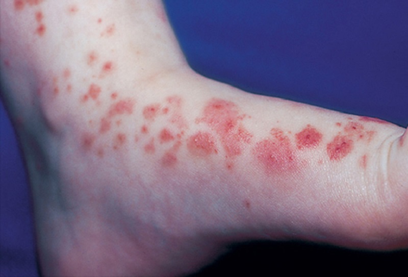 Phát ban trên da là một trong những triệu chứng phổ biến.