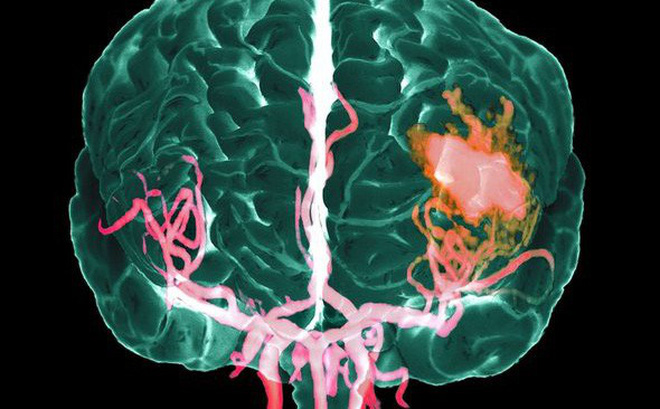 Xuất huyết nhu mô não là tình trạng chảy máu xảy ra trong nhu mô não, mô chức năng trong não bao gồm các tế bào thần kinh và tế bào thần kinh đệm. 