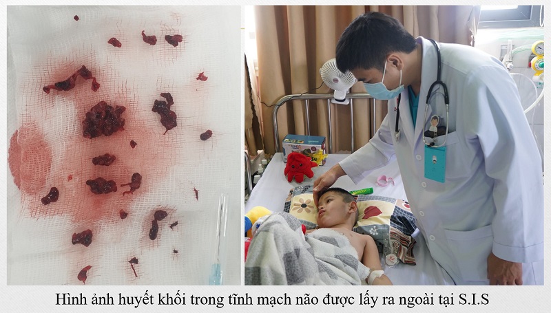 Bé L. sức khỏe đã ổn định sau 5 ngày điều trị tích cực