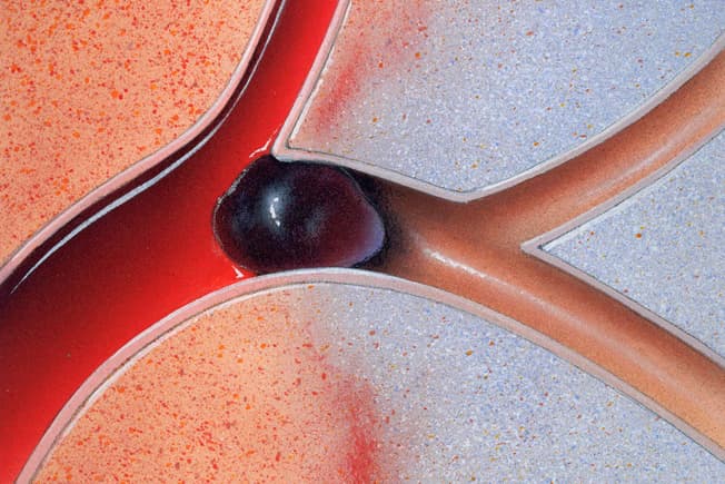 Đột quỵ do thiếu máu cục bộ là loại đột quỵ phổ biến nhất.