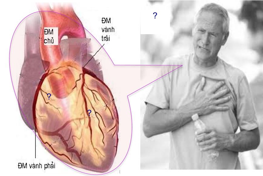 Bóc tách động mạch vành làm tăng nguy cơ nhồi máu cơ tim?