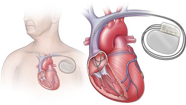 Đặt máy tạo nhịp tim ba buồng có chức năng khử rung cho bệnh nhân.