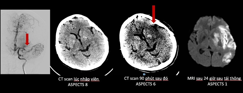 Lời giải cho việc điều trị đột quỵ do tắc nhiều mạch máu