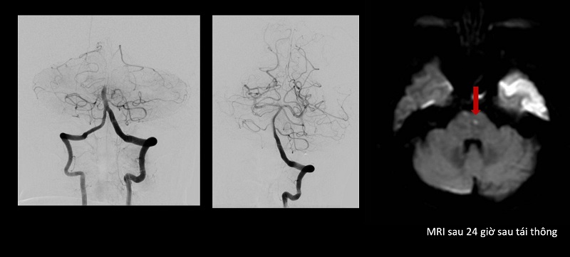 Hình ảnh CT bệnh nhân lúc nhập viện và MRI sau tái thông.