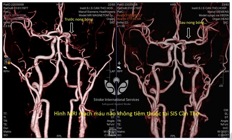 Phát hiện thiếu máu não thoáng qua, 2 bệnh nhân kịp thời ngăn chặn đột quỵ