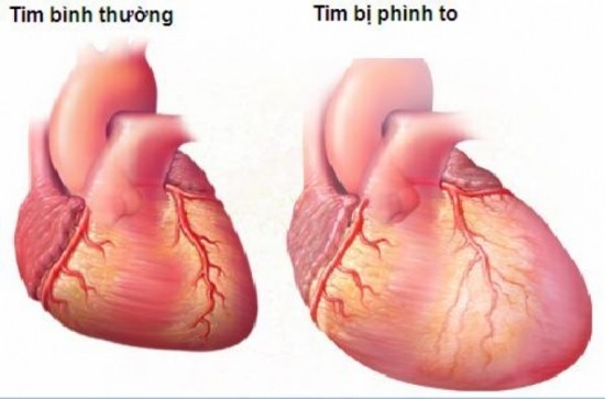 Tim to (cardiomegaly) hay còn gọi là bệnh cơ tim phì đại, xảy ra khi một số cơ tim vì một số lí do mà dày lên và phình to ra.