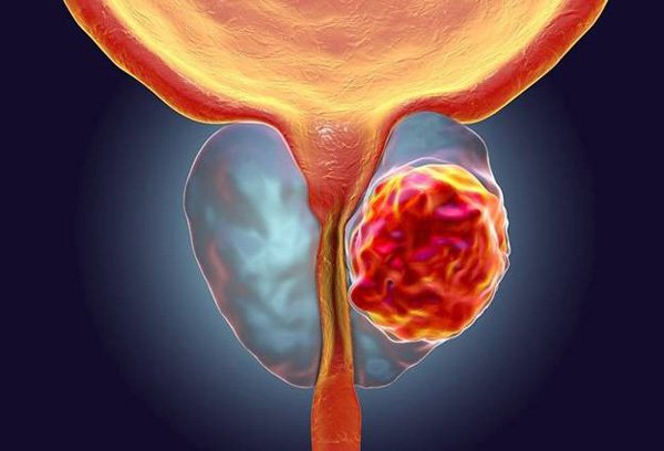 Không rõ nguyên nhân gây ra ung thư tuyến tiền liệt, nhưng các yếu tố nguy cơ như tiền sử gia đình hoặc tuổi tác có thể làm tăng khả năng phát triển bệnh ác tính.