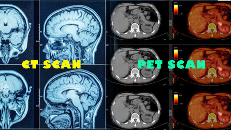 Chụp cắt lớp vi tính (CT) sử dụng tia X. Chụp PET scan sử dụng một chất đánh dấu phóng xạ để cho biết cơ quan đang hoạt động như thế nào trong thời gian thực.