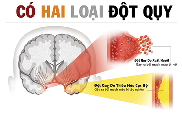 Đột quỵ do thiếu máu cục bộ chiến hơn 80% và đột quỵ xuất huyết chiếm khoảng 20% các trường hợp đột quỵ.