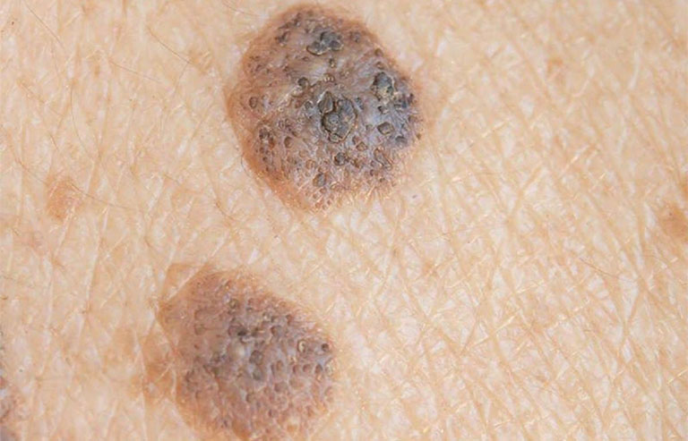 Dày sừng ánh sáng