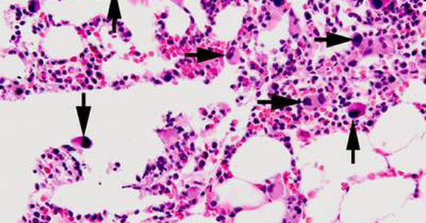 MDS phát triển khi có sự cố xảy ra với quá trình sản xuất tế bào máu.