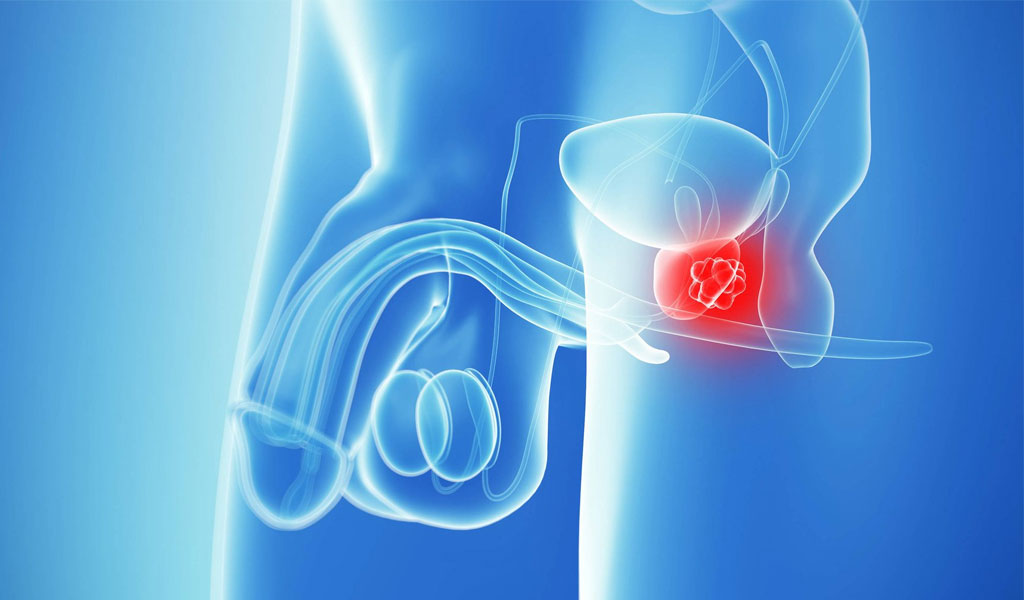 Phẫu thuật cắt bỏ tinh hoàn là một trong những phương pháp điều trị của liệu pháp hormone.
