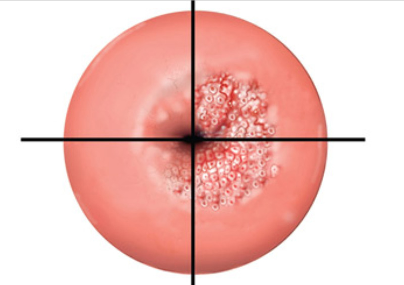 Loạn sản cổ tử cung