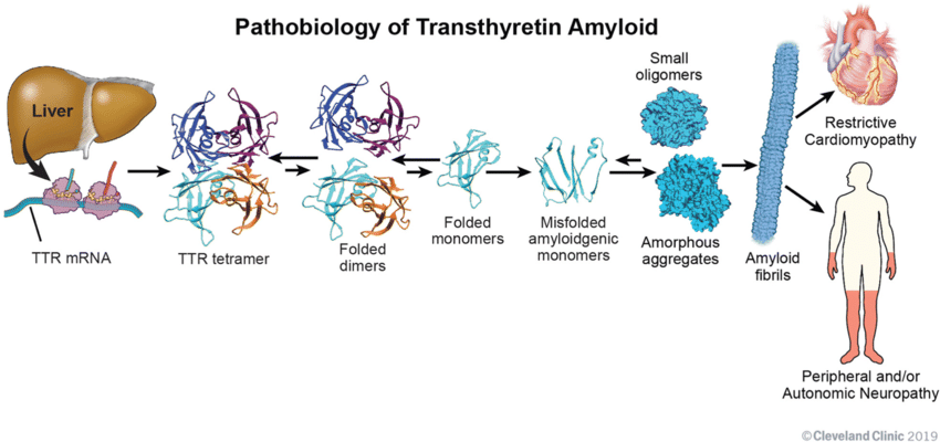 Bệnh cơ tim Transthyretin amyloidosis (ATTR-CM) là một chứng rối loạn protein.