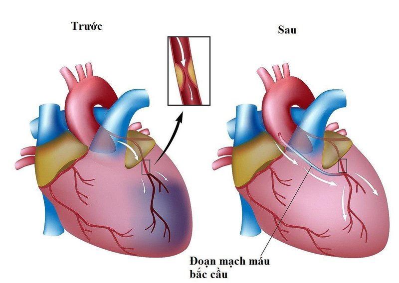 Phẫu thuật ghép bắc cầu động mạch vành (CABG) liên quan đến việc sử dụng mảnh ghép mạch máu để bắc cầu một hoặc nhiều động mạch vành bị tắc nghẽn.