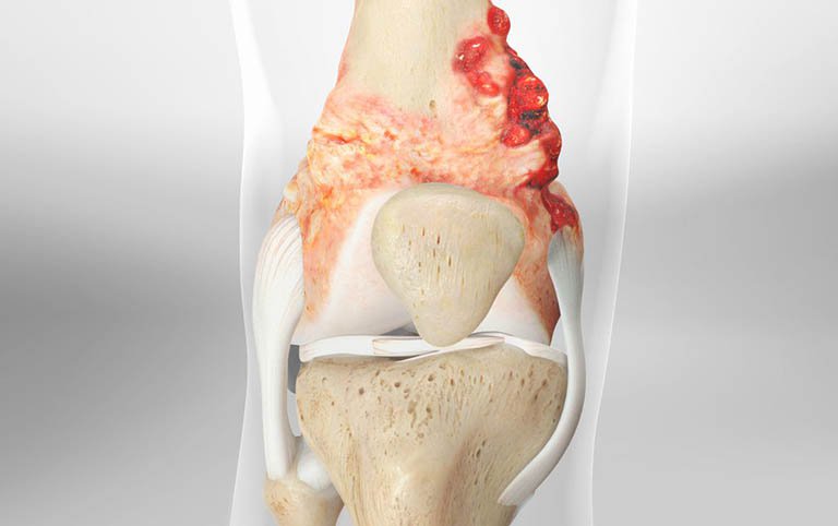 Sarcoma hình thành khi các tế bào xương hoặc mô mềm chưa trưởng thành có những thay đổi đối với DNA của chúng và phát triển thành các tế bào ung thư phát triển theo cách không được kiểm soát.