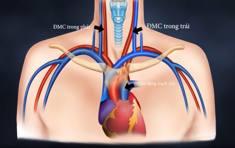 Động mạch cảnh có kích thước khá lớn, nằm ở cổ, gồm có động mạch cảnh trái và động mạch cảnh phải mà ta có thể sờ thấy được nhịp đập