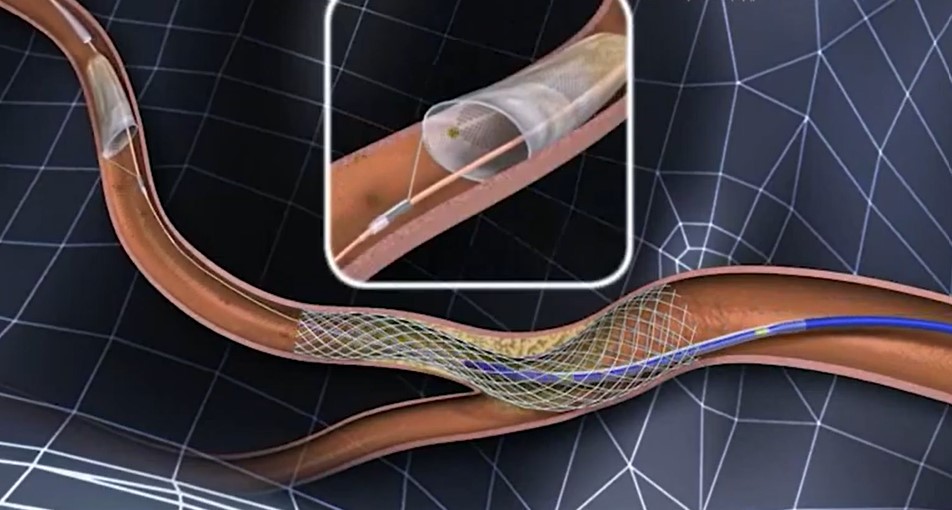 Đặt stent động mạch cảnh được chỉ định cho các bệnh nhân bị hẹp động mạch cảnh mức độ nặng từ 70% trở lên