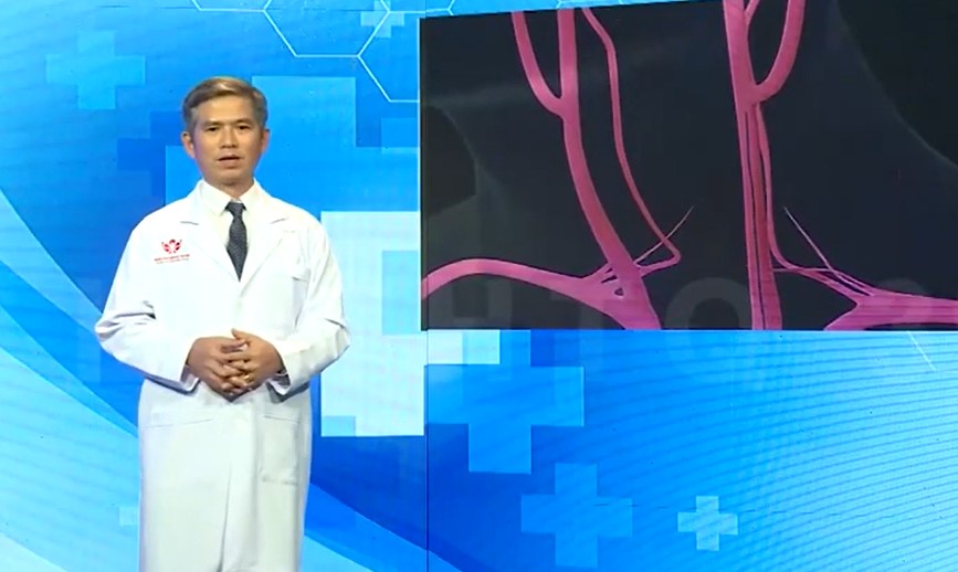 Cách điều trị đột quỵ do hẹp động mạch cảnh