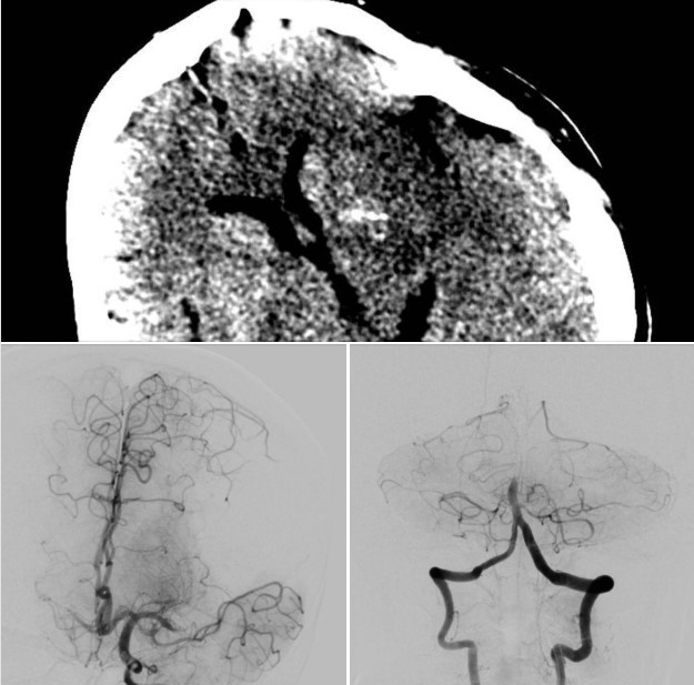 Đột quỵ cấp do tắc nhiều mạch máu, vấn đề nan giải với các bác sĩ
