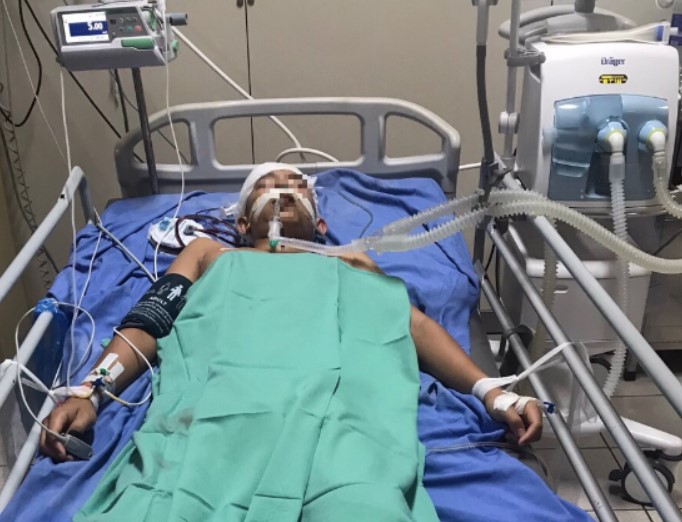 Hòa Bình: Nam sinh 16 tuổi bị đột quỵ xuất huyết do dị dạng mạch máu não