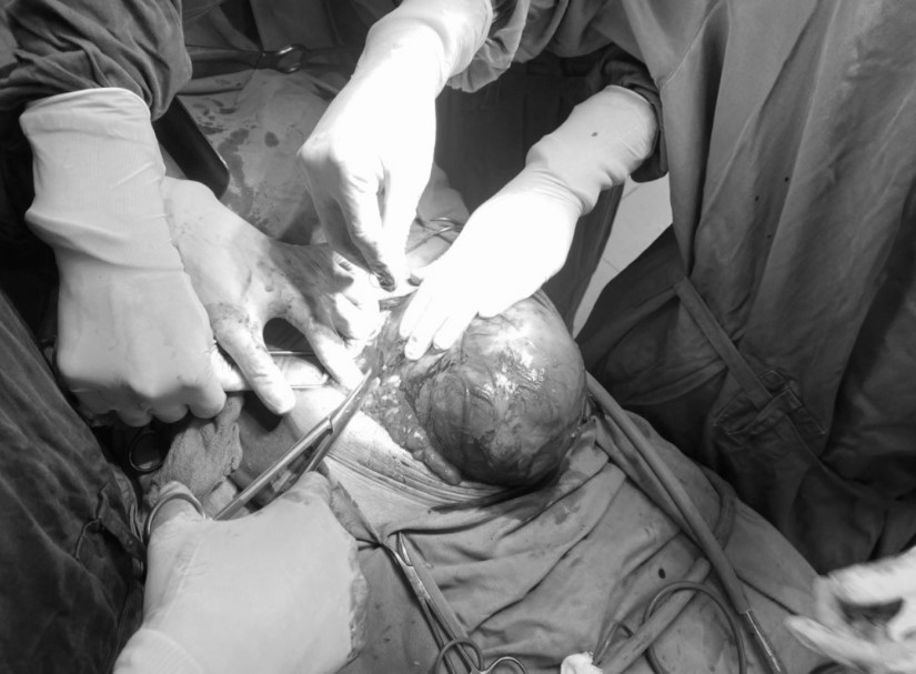 Người đàn ông 72 tuổi bị đột quỵ kèm khối u lớn trong bụng