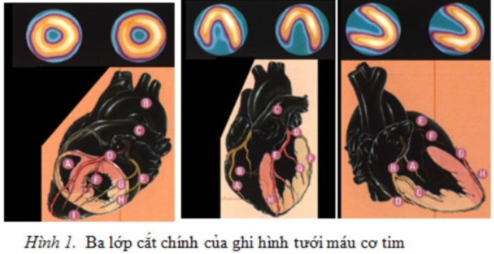  Xạ hình cơ tim cho biết vùng khuyết xạ là vùng cơ tim bị nhồi máu.