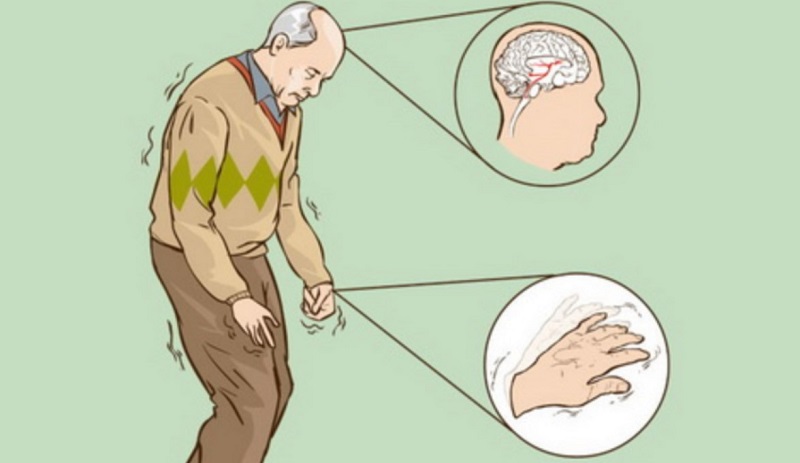 Đột quỵ gây tổn thương não có thể khiến bệnh nhân bị Parkinson