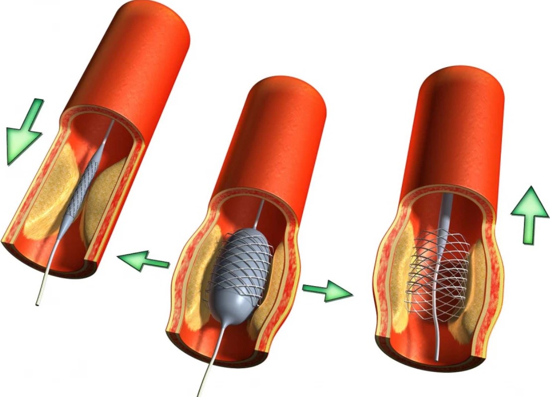 Nong mạch và đặt stent là kỹ thuật điều trị hiện đại cho các bệnh lý hẹp mạch máu.