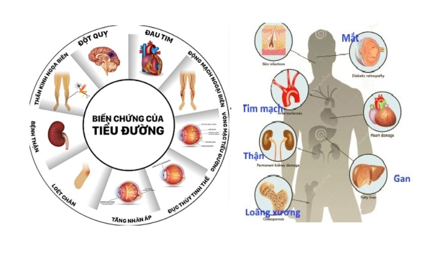Tiểu đường và tăng huyết áp không điều trị đều dẫn đến những biến chứng nguy hiểm.