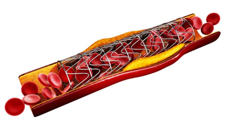 Hình thành huyết khối sau đặt stent có thể dẫn đến đột quỵ
