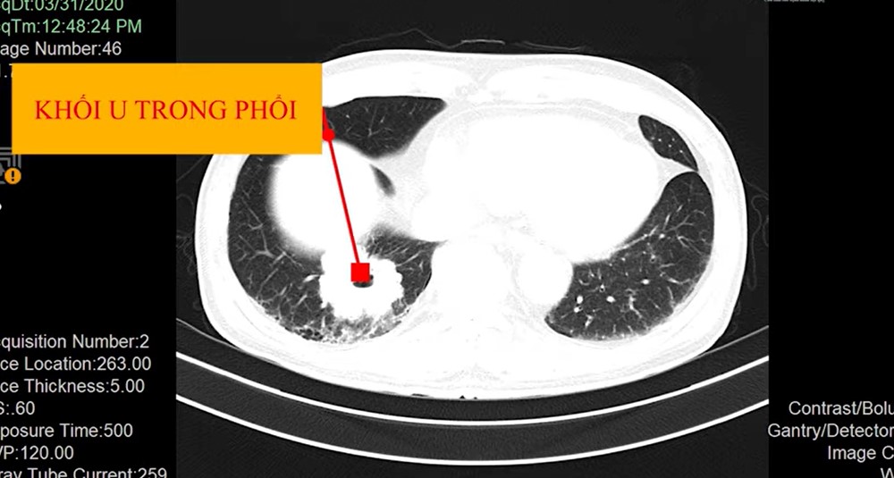 khối u trong phổi