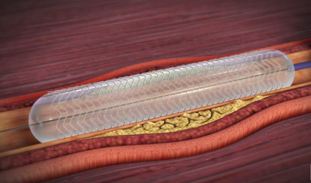 Đặt stent là phương pháp được sử dụng phổ biến hiện nay