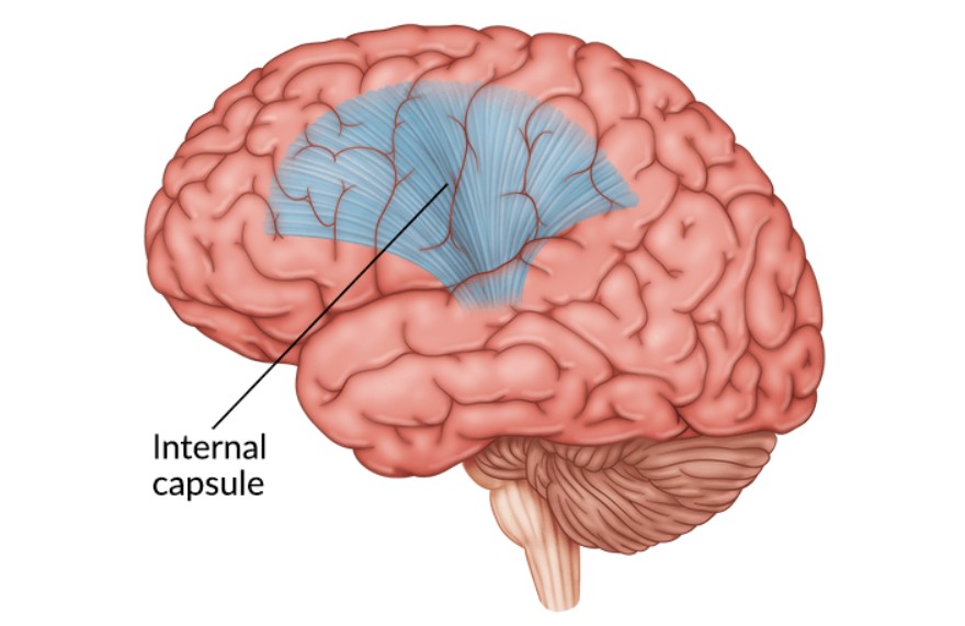 Đột quỵ bên trong nang não: Triệu chứng và sự phục hồi