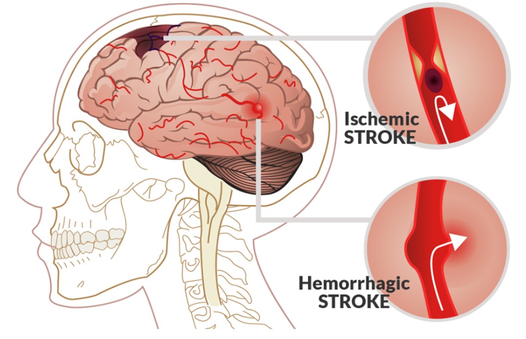 Đột quỵ xảy ra do vỡ mạch hoặc tắc mạch.