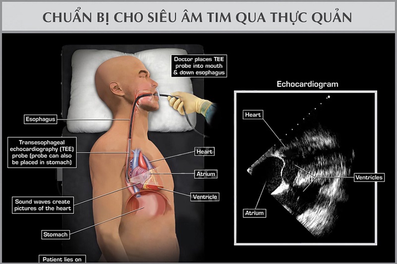 Thông thường, siêu âm tim qua thực quản chỉ cần gây tê tại chỗ và dùng thuốc an thần vừa phải.