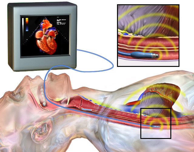 TEE là một xét nghiệm sử dụng sóng âm thanh để tạo ra hình ảnh về trái tim.