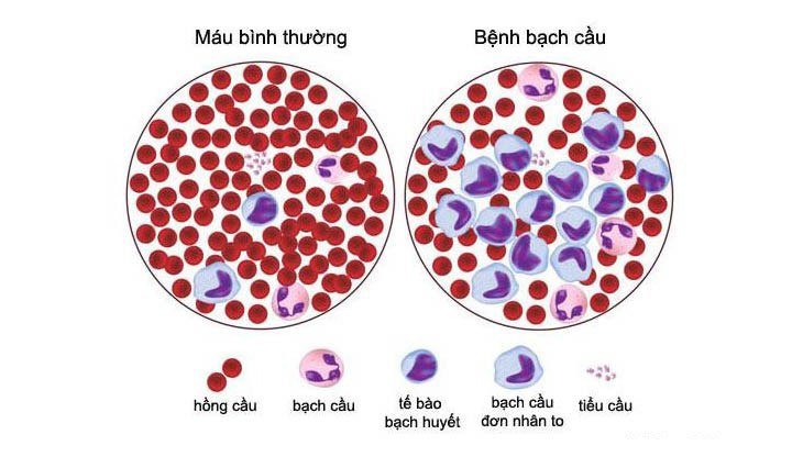 Bệnh bạch cầu bắt đầu khi DNA của một tế bào đơn lẻ trong tủy xương đột biến.